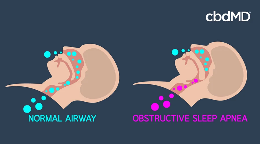 Graphic depicting a normal airway compared to the airway of a person with obstructive sleep apnea
